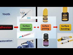 Keys to successful ceramic bonding. Dr Taher Khattab