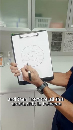 This is how an areola reduction is done #revisionsurgery #chestsurgery #areolareduction #gyno