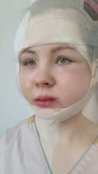 Before and After for Full Face Contouring & Facelifting ❤️‍🔥