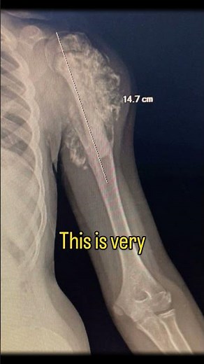 Bone cancer or any serious disease is truly unfortunate… #osteosarcoma