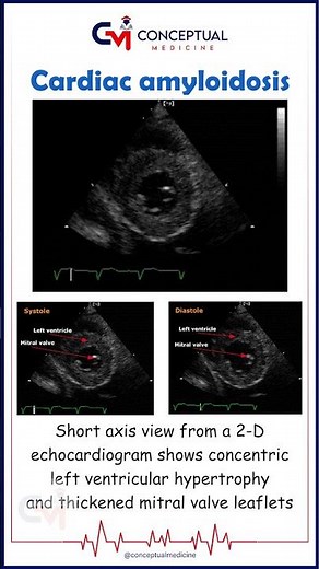 Cardiac Amyloidosis on Echo 💔🌀 | USMLE Final Aid