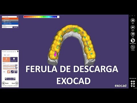 Ferula de descarga con exocad