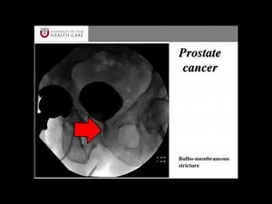 Radiation Injury and Prostate Cancer • Video • MEDtube.net