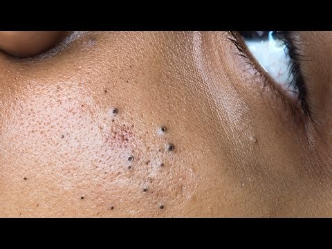 Extreme Blackhead Removal | Ultimate Deep Facial Cleansing Experience for Clear Skin