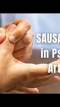 Sausage Digit in Psoriatic Arthritis