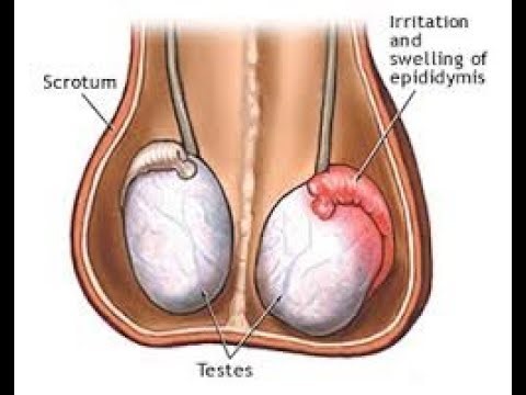 Acute scrotal pain; in children and adults an urological emergency