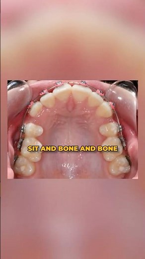 Can Braces Change Your Face Shape?