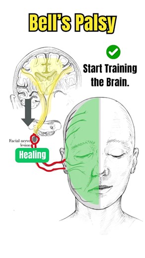 The Brain heals Bell’s palsy before the facial nerve does. 🧠✨ Recovery doesn’t start at the face — it starts in the brain.💪 Before the facial nerve regenerates, the brain reorganizes, adapts, and relearns control.✨ That’s why early rehabilitation should train the brain, not force the muscles.🚨 ✔ Neuroplastic activation ✔ Sensory–motor retraining ✔ Gentle, intention-based movements 👉 Respect the timeline of healing.🧠 👉 Teach the brain first — the face will follow.✅✅ Neurophysiology over for