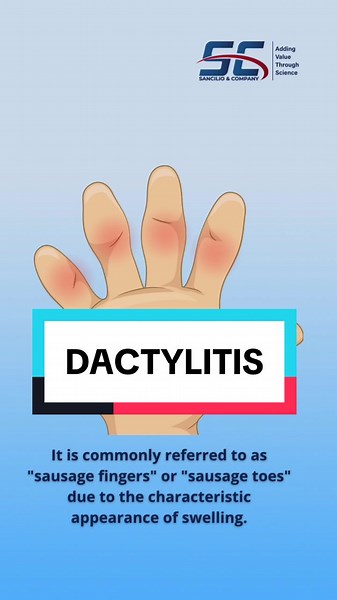 Understanding Dactylitis: Causes, Symptoms, and Treatment