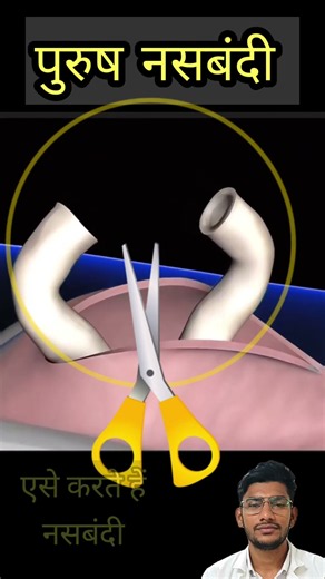 Vasectomy Procedure 😱...#vasectomy#malesterilization#youtubeshorts #shortvideo#pregnancy #vasectomy
