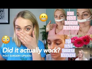 WHAT TO EXPECT AFTER NASAL SURGERY 2021 | Three Years Post-Sinus (Septoplasty) Operation Recovery!