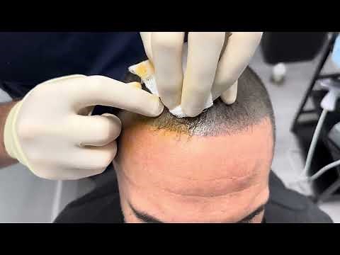 How To Safely Drain Abscess After Hair Transplant: Expert Care Guide