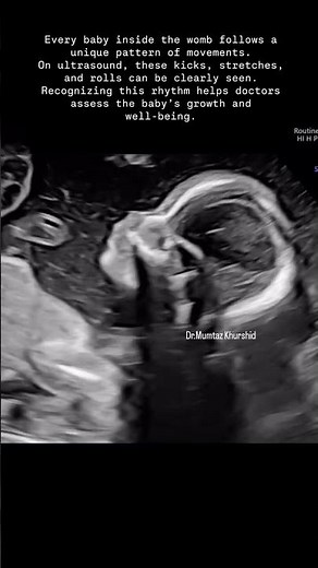 Every Baby Has a Unique Movement Pattern on Ultrasound
