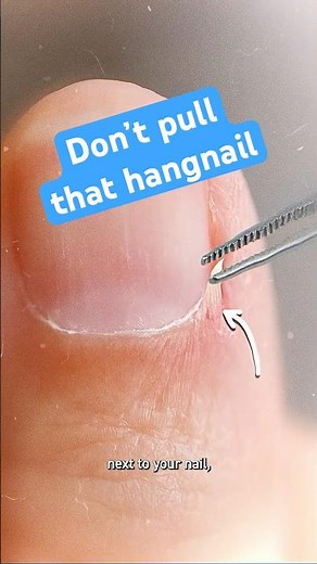 Don't Pull That Hangnail