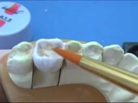 Molar build up