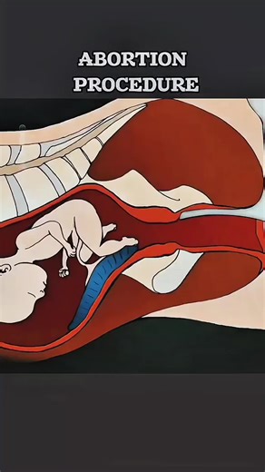 What Happens During An Abbortion? (3D Animation) #abortion #abortionprocess #birth #dilationandcurettage