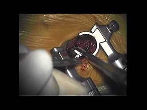 Lumbar Fusion of Minimal Invasion • Video • MEDtube.net