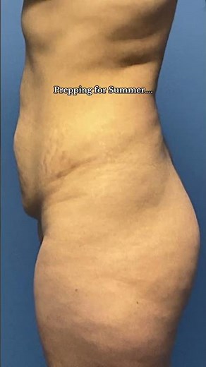 Tummy Tuck Before & After: Real Results, Real Healing