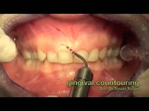 gummy smile treatment