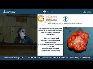 Ультразвуковая диагностика рака молочной железы. Разбор клинического случая