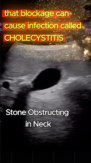 Gallbladder Infection Ultrasound: Early Diagnosis is Important !!