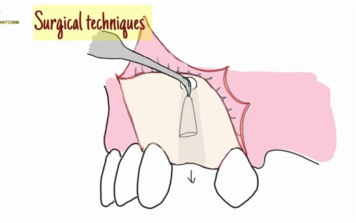 4 ways to extract broken root tips and when to LEAVE THEM ALONE -mentaldental -D