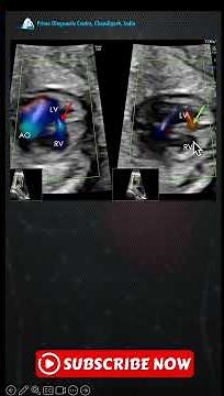 Fetal Muscular VSD: Color & M-Mode Doppler Reveal Stunning Bidirectional Flow! 💓🩻