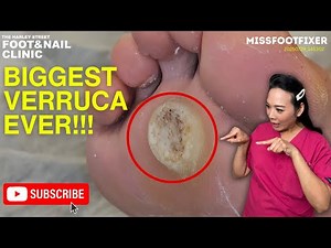Part 1: BIGGEST VERRUCA EVER 😱 | Most Satisfying Removal!