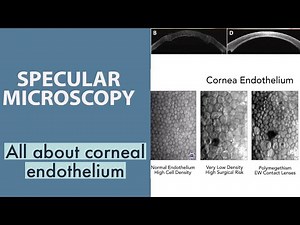 Specular microscopy || Endothelial changes ||Fuchs corneal endothelial dystrophy