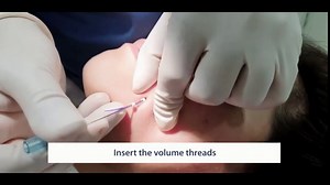 Pdo Thread(multi 20lines 21G 38MM) For Face Long Lasting Lift Threads Multi Lifting Blunt Thread(20pieces)