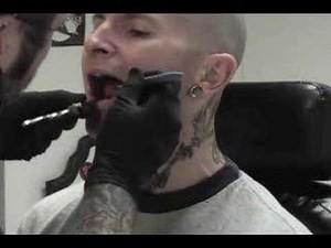 Critter's Lingual frenectomy