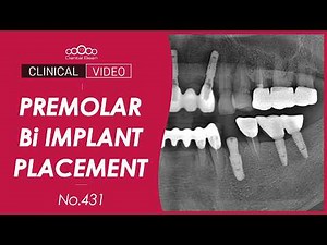 Immediate implant placement on #34 with Bi implant [Dr. Jeon Inseong]