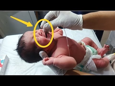 Newborn NG Tube Insertion | Safe Step-by-Step Clinical Procedure plzz Subscribe
