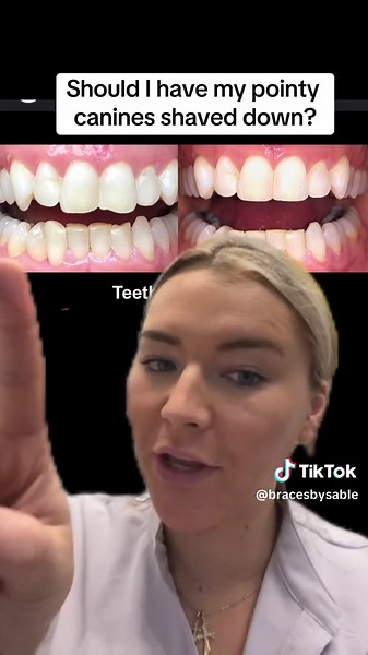 Should I have my Pointy Canines Shaved Down?