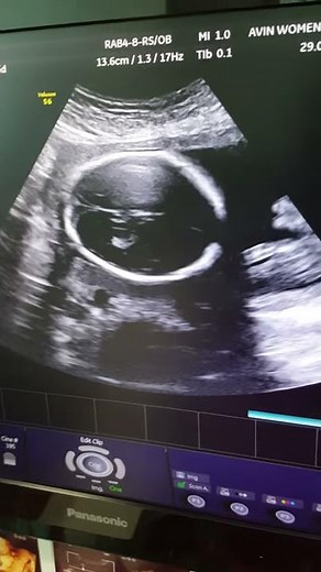 Baby heart beat sound in womb ultrasound scanning 23 weeks (kaurwaki)