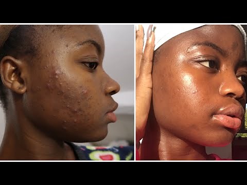 Bilan 2 mois Traitement curacné/roaccutane/ Accutane Treatment Peau noire/dark skin
