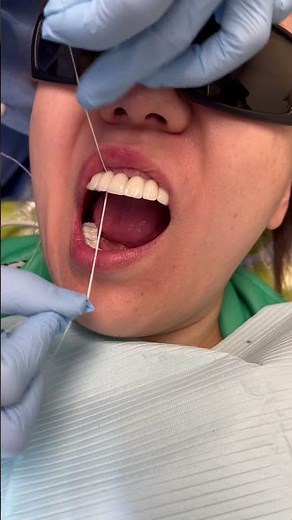 how to do flossing for implant bridge