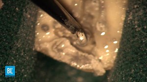 Clinical case from Dr. Jorge Vera using CK Tip and Vibrapost! For...