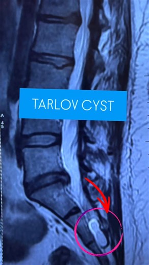 Dr. Rahul Sharma on Instagram: "What is a Tarlov cyst? Also known as Perineural Cyst, a Tarlov cyst is a fluid‑filled sac on the nerve roots of the spine, often in the lower back. Most are harmless and found by chance, but larger ones can cause pain, numbness, bladder/bowel issues, or sexual dysfunction. How common? Around 4% of people may have them, but only 5–8% develop symptoms. You might notice the change in pressure while doing strenous exercises for activities like lifting heavy weights. T