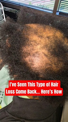 Can Hair Grow Back After Scarring Alopecia? (Houston Hair Restoration)