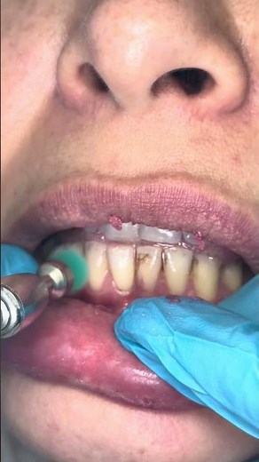 Teeth Scaling Close-Up | Professional Dental Cleaning