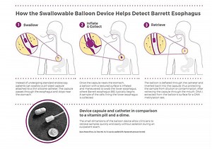 New Technology Gives Patients Access to a 5-Minute, Office-Based Test to Identify Risk for Esophageal Cancer