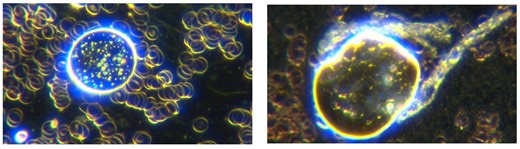 Dynamic Self Assembly Process Of Microchips and Filaments by Microrobots Captured On Darkfield Microscopy in COVID19 Unvaccinated Blood