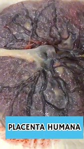 La placenta es un órgano que se desarrolla en el útero durante el embarazo. Esta estructura provee oxígeno y nutrientes al bebé en crecimiento. También elimina los productos de desecho de la sangre del bebé. La placenta se adhiere a la pared del útero y de ella surge el cordón umbilical. #baby #placenta #nutrientes #salud #sangre #gine #información #InstaMed | Dr. Med. Alejandro Moreno