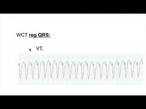 QRS complex