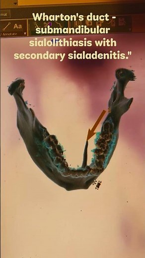 CT shows a hyperdense Wharton's duct - submandibular sialolithiasis with secondary sialadenitis."