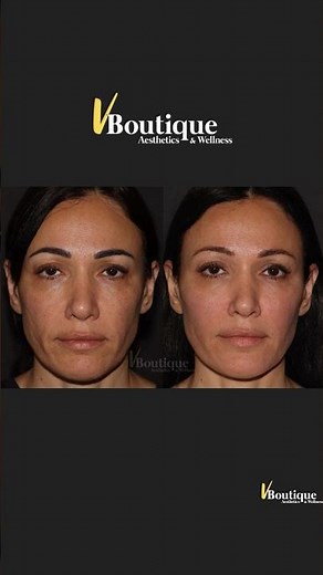 VBoutique - Dr V - Before & After Sculptra and Secret RF Microneedling