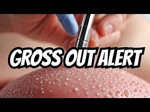 Exploding Pus-Filled Pimples – Grossly Satisfying Extraction Compilation!