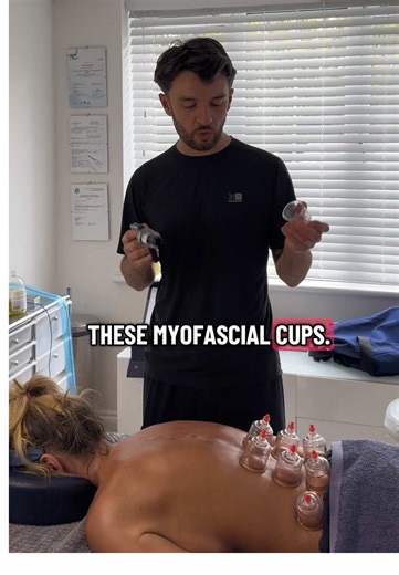 Where does cupping come from? Cupping comes from ancient traditional Chinese medicine, where healers used hollowed animal horns or bamboo cups to create suction on the skin. The idea was to balance the body's energy, or qi, and pull out toxins or stagnant blood. The practice spread to Egypt, Greece, and the Middle East, with records dating back over 3,000 years. 🗿 The science we know now ? Cupping creates negative pressure, which pulls blood vessels close to the skin’s surface, increasing blood