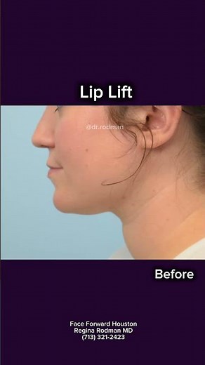 Lip Lift| Lip Augmentation| Before and After